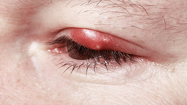 blepharitis