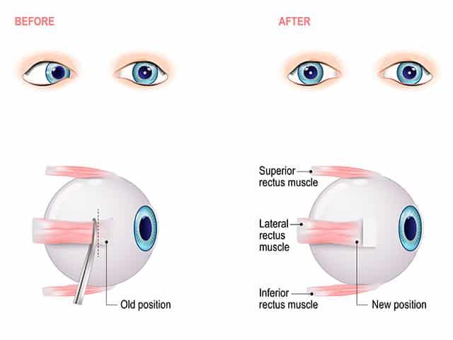 Esotropia surgery before and after