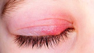 stye-treatment